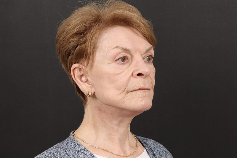 Neck Lift Before & After Image