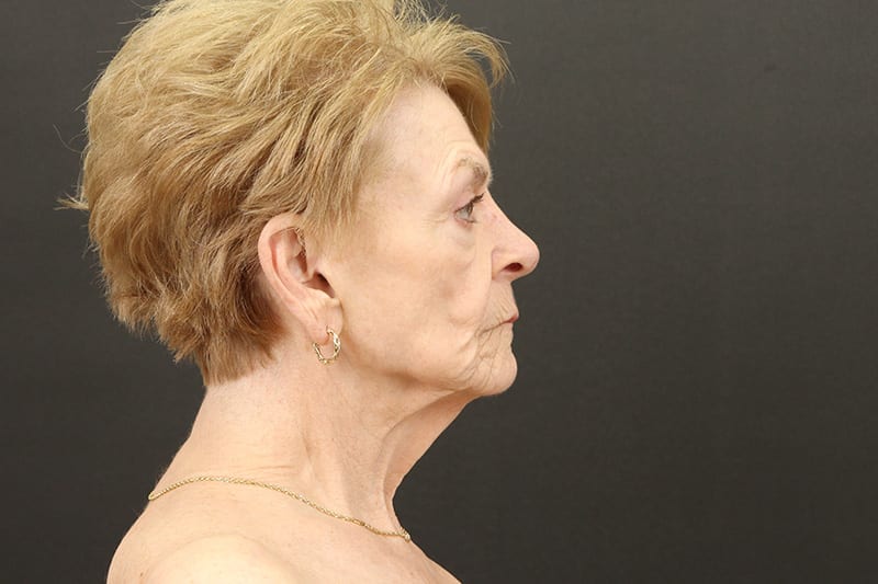 Neck Lift Before & After Image