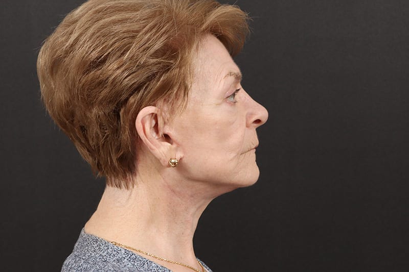 Neck Lift Before & After Image