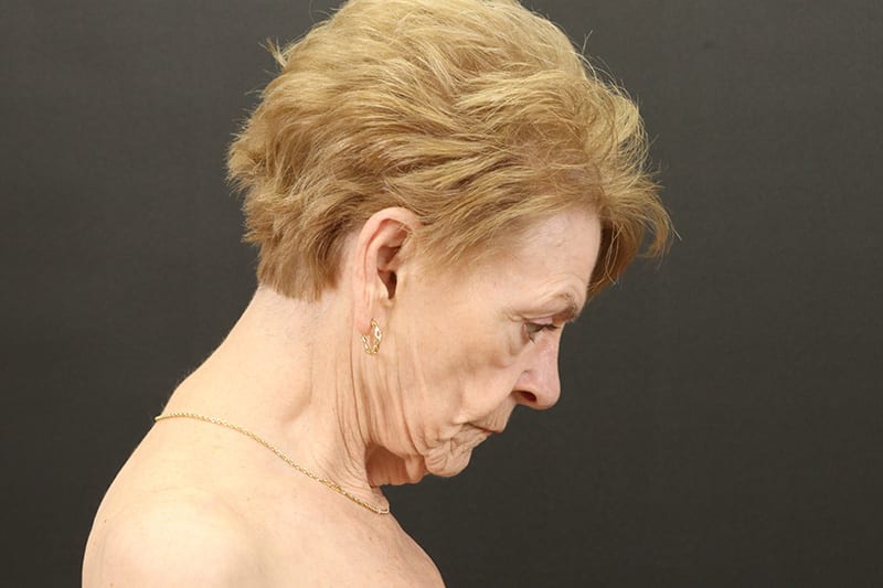 Neck Lift Before & After Image