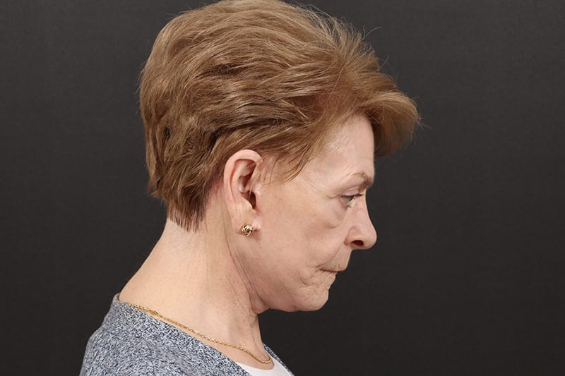 Neck Lift Before & After Image