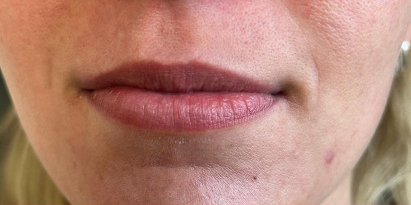 Lips Before & After Image