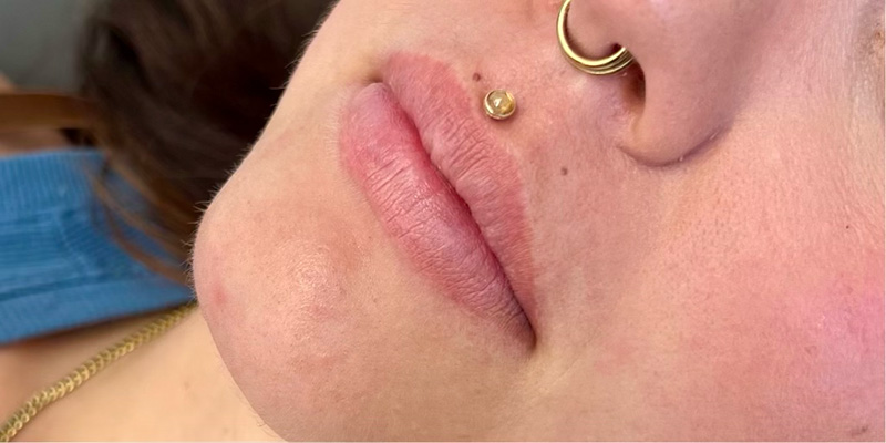 Lips Before & After Image