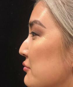 Non-Surgical Rhinoplasty Before & After Image