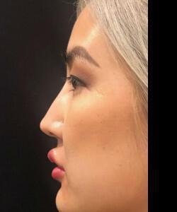 Non-Surgical Rhinoplasty Before & After Image