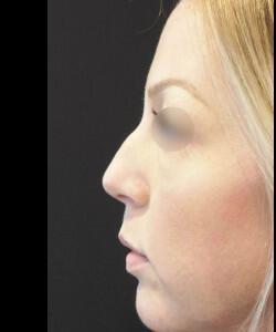 Non-Surgical Rhinoplasty Before & After Image