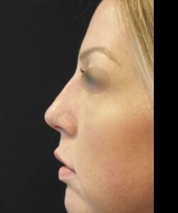 Non-Surgical Rhinoplasty Before & After Image