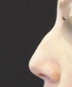 Non-Surgical Rhinoplasty Before & After Image