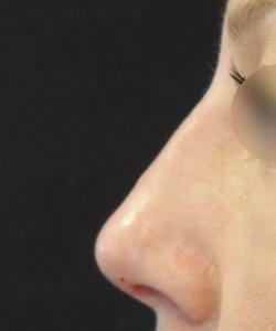 Non-Surgical Rhinoplasty Before & After Image