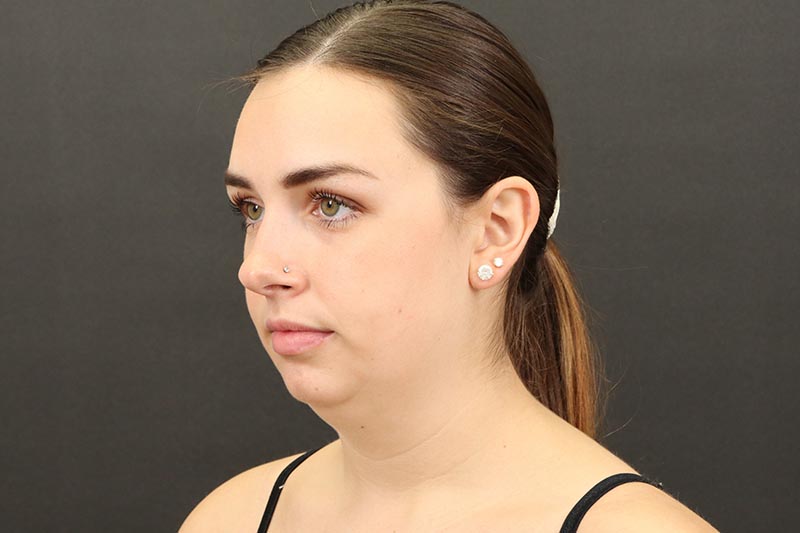 Neck Lift 1