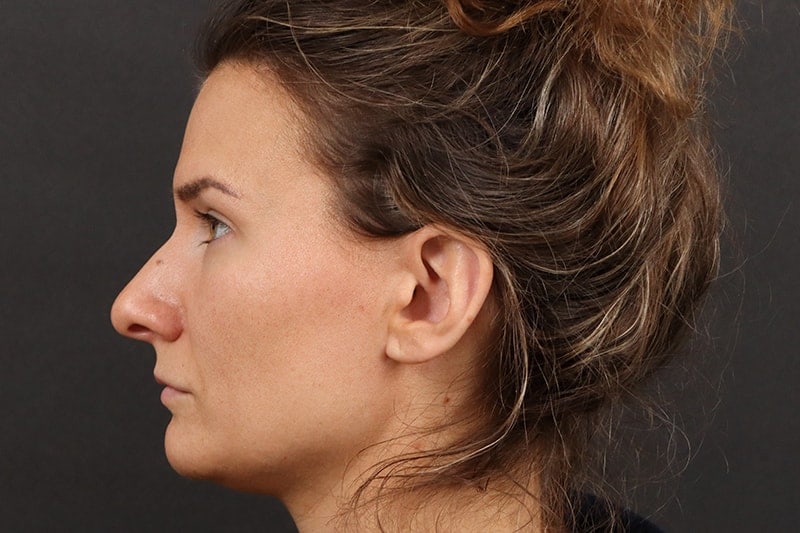 Rhinoplasty 3