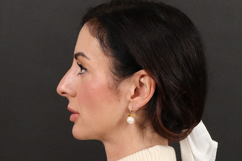 Rhinoplasty 4