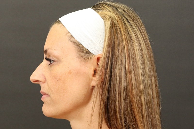 Rhinoplasty 5