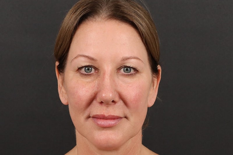 Blepharoplasty 1