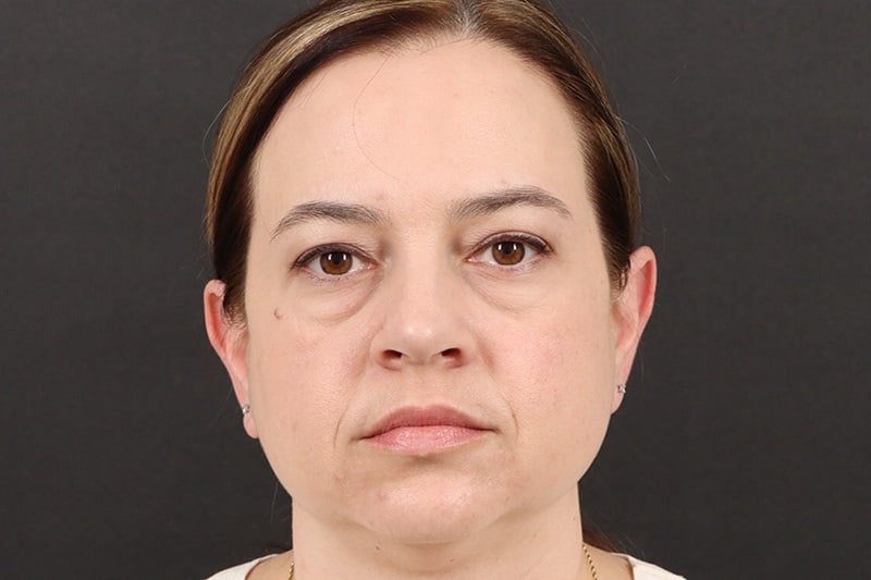 Blepharoplasty 3