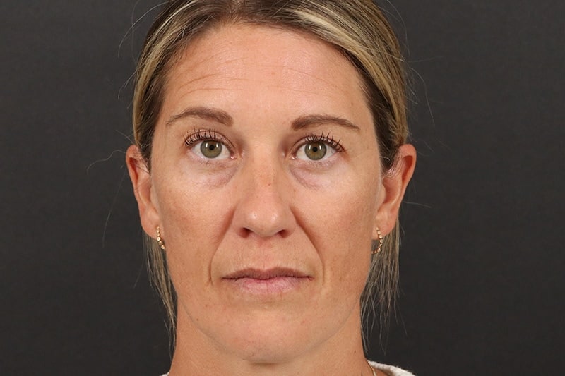 Blepharoplasty 5