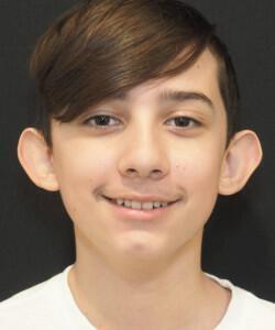 Otoplasty 1