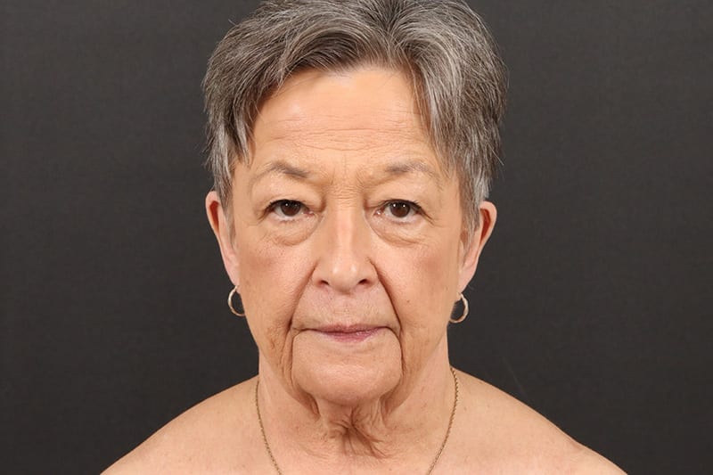 Face and Neck Lift 1