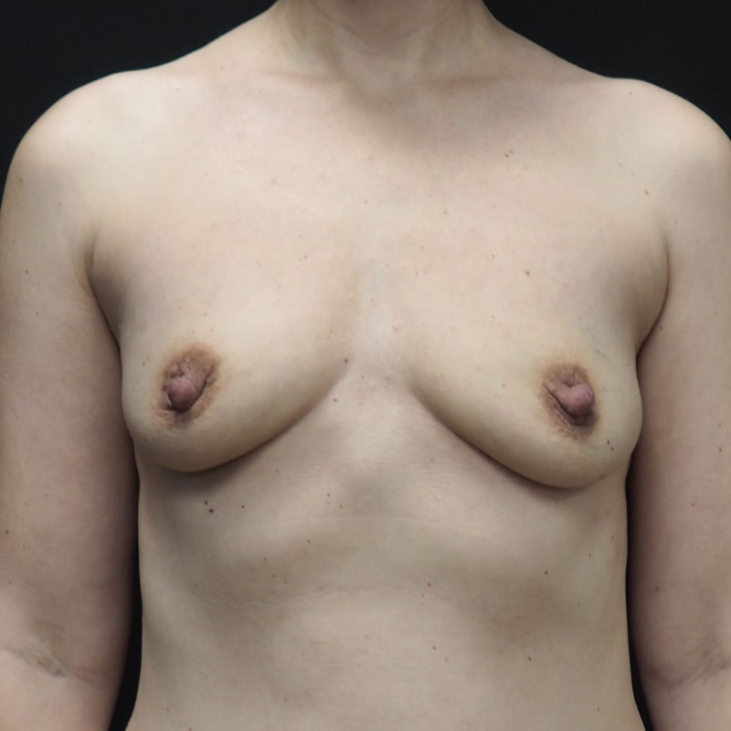Breast Augmentation 5