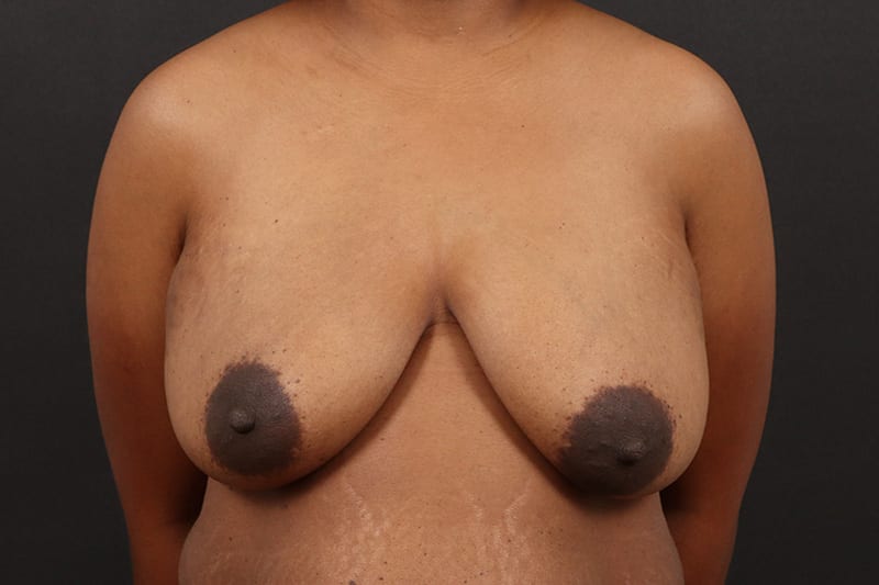 Breast Reduction 3
