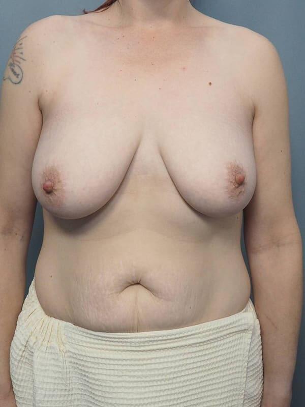 Breast Lift 4