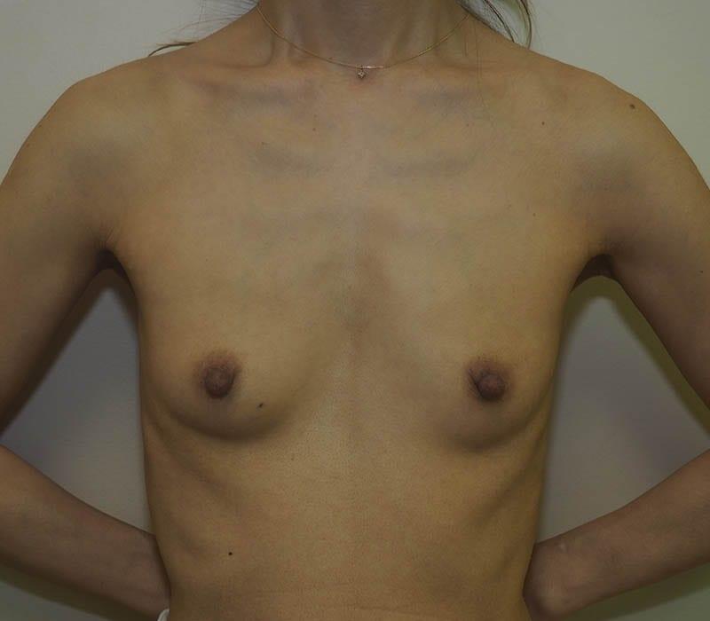 Breast Reconstruction 1