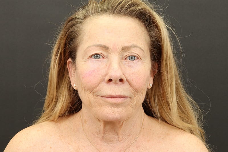 Face and Neck Lift 4-1