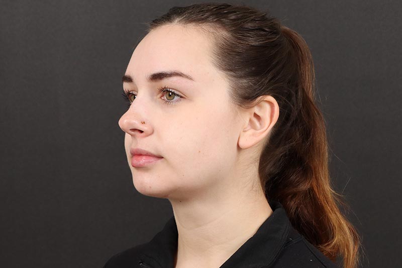 Neck Lift 2