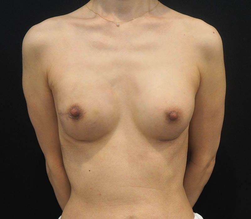 Breast Reconstruction 2