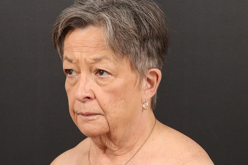 Face and Neck Lift 3