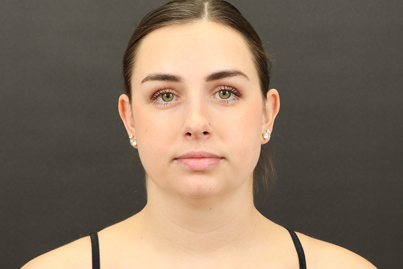 Neck Lift 3