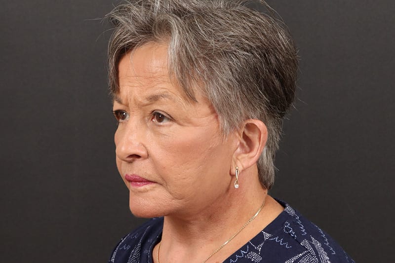 Face and Neck Lift 4