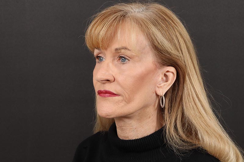 Face and Neck Lift 5-4