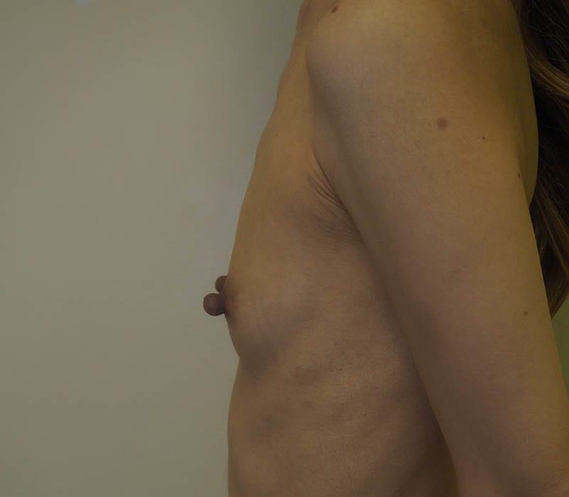 Breast Reconstruction 5