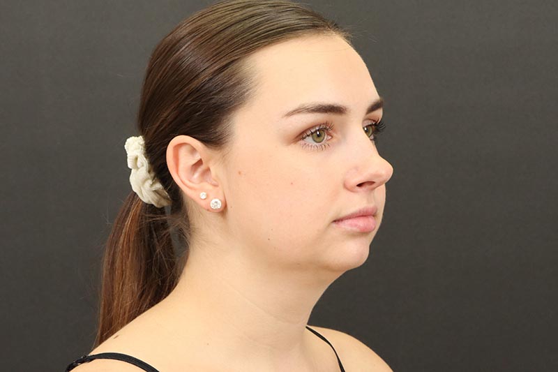 Neck Lift 5